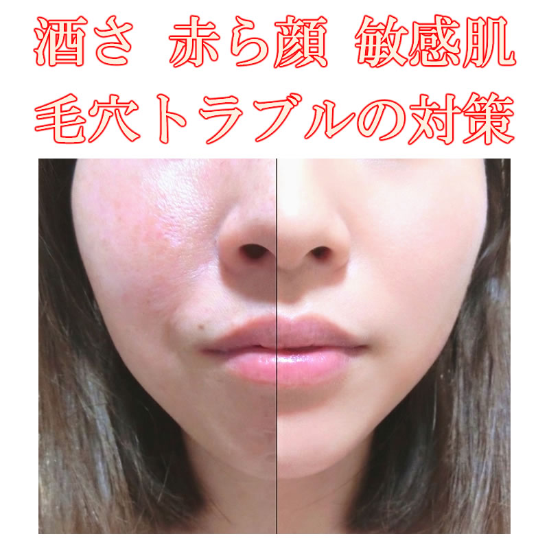 酒さ 赤ら顔 綺麗な肌