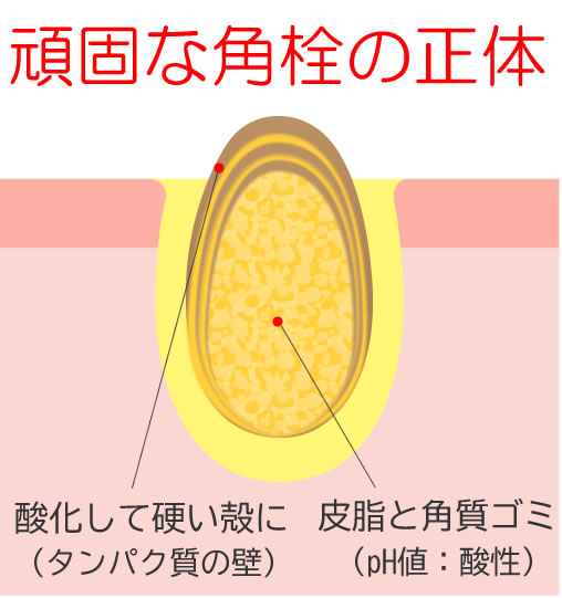 頑固な角栓の正体