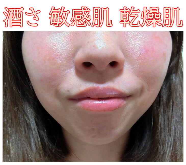 酒さ 敏感肌 乾燥肌