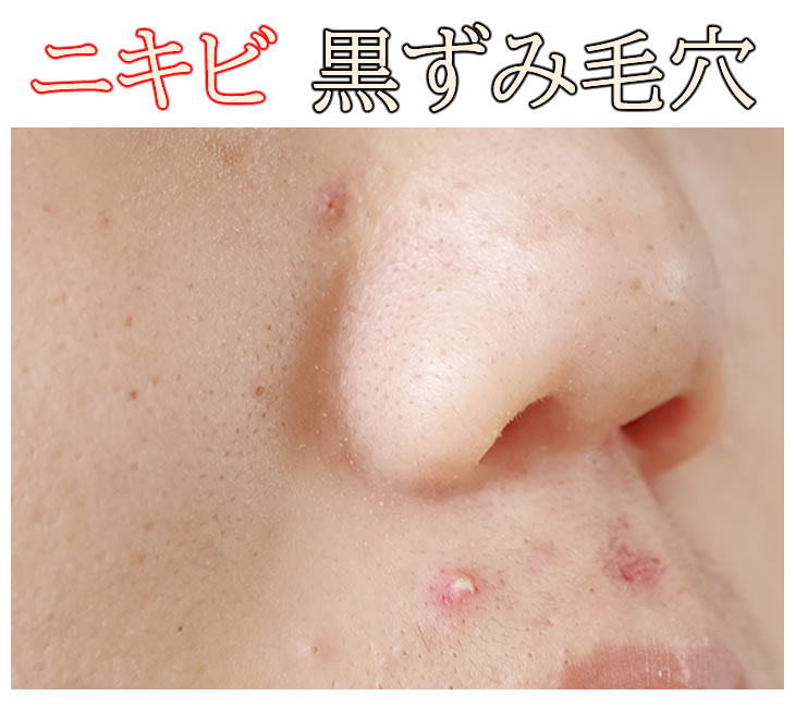 水溶性ジェル クレンジング 界面活性剤不使用 オイルフリー 酒さ 敏感